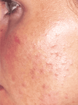 Acne Treatment 1 - Before