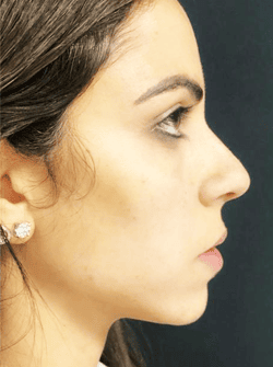 Chin Injections and Jawline Injections 11 - After