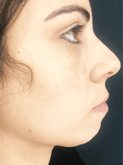 Chin Injections and Jawline Injections 11 - Before