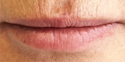 Lip Refresh Lip Injections 1 - Before