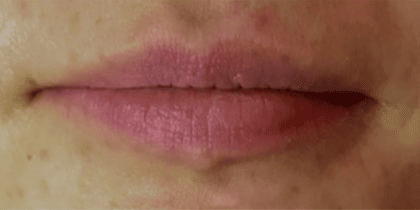 Lip Refresh Lip Injections 4 - Before