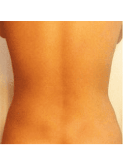 Love Handles Cryolift - After