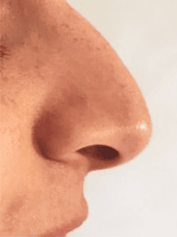 Non-surgical rhinoplasty noselift 1 - Before