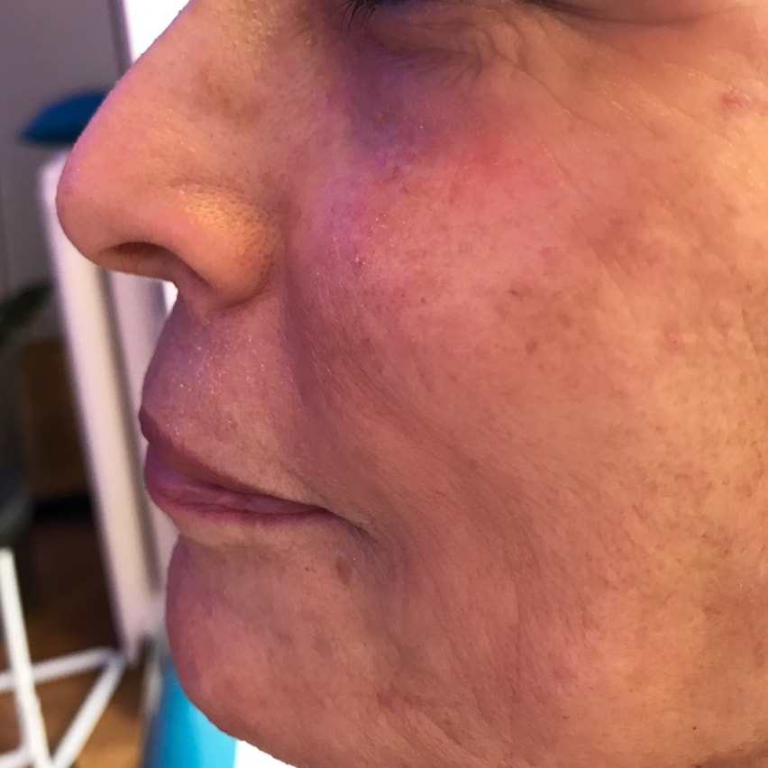 Skin Boosters, Polynucleotides, Sculptra, Neauvia, and Radiesse Calcium - After