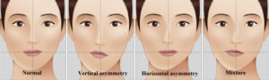 Facial Asymmetry